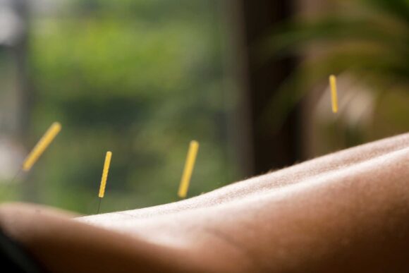 Acupuncture
